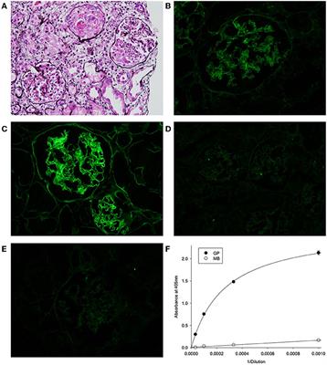 Molecular Analysis of Goodpasture’s Disease Following Hematopoietic Stem Cell Transplant in a Pediatric Patient, Recalls the Conformeropathy of Wild-Type <mark class="highlighted">Anti-GBM Disease</mark>